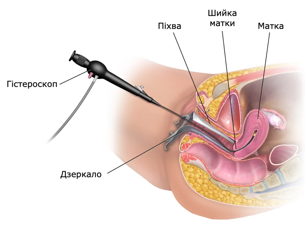Гістероскопія