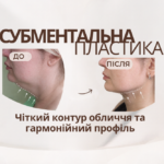 Субментальна пластика у Вінниці: корекція підпідборідної ділянки